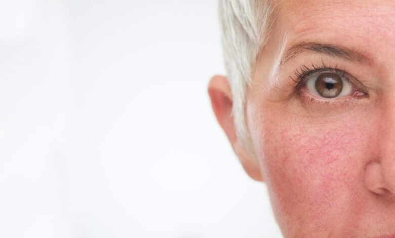 Cómo cuidar la piel con rosácea 1 cuidar la piel con rosacea