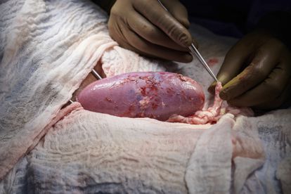 Trasplantado con éxito un riñón de cerdo a una mujer en muerte cerebral 2 Un cirujano maneja el riñón de cerdo trasplantado a una mujer en muerte cerebral, el 25 de septiembre, en el Centro Médico Langone de la Universidad de Nueva York.