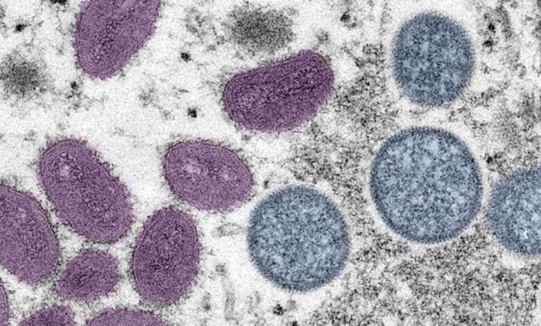 Viruela del mono puede ser mortal para quienes tienen VIH o un sistema inmune débil: estudio 1 Viruela del mono puede ser mortal para quienes tienen VIH o un sistema inmune débil: estudio